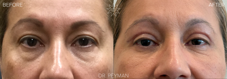 Before and after of a female patient’s quad blepharoplasty by Dr. Jason Sabet-Peyman in Orange County. The image demonstrates the restoration of the "eyelid platform"—the visible space above the lashes—creating a brighter, more open appearance.