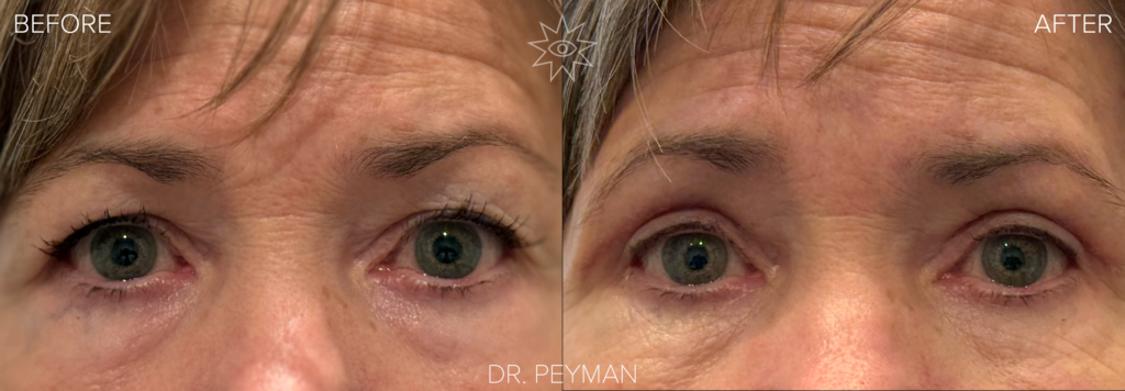 Before and after of a female patient just one month after eyelid surgery by Dr. Jason Sabet-Peyman in Orange County, showing a fully healed, natural, and camera-ready appearance.