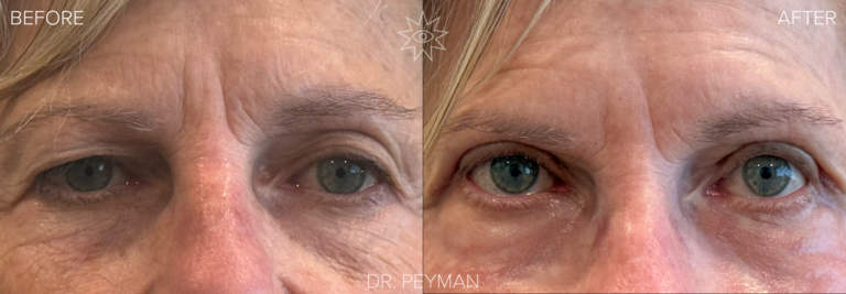 Before and after of a female patient's upper eyelid blepharoplasty by Dr. Sabet-Peyman in Orange County. The image shows the removal of heavy, hooded skin to reveal a brighter, wider, and more open gaze.