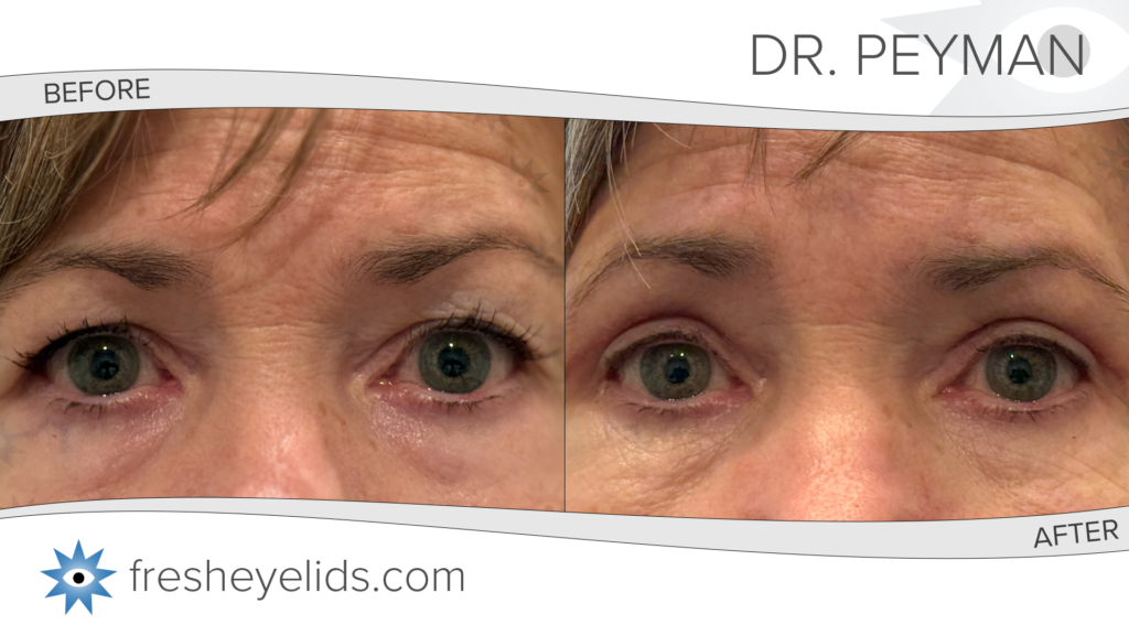 Before and after of a female patient just one month after eyelid surgery by Dr. Jason Sabet-Peyman in Orange County, showing a fully healed, natural, and camera-ready appearance.