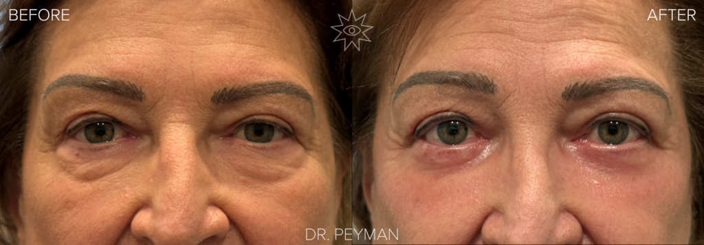 Before and after lower eyelid blepharoplasty showing under‑eye bags replaced with a smoother, refreshed lower lid contour after a safe, 45‑minute awake procedure performed by oculoplastic surgeon Dr. Jason Sabet‑Peyman in Fullerton, Orange County.