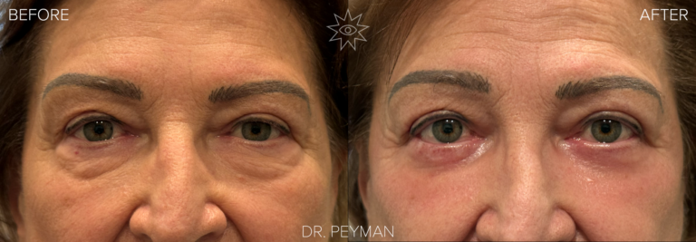 Before and after lower eyelid blepharoplasty showing under‑eye bags replaced with a smoother, refreshed lower lid contour after a safe, 45‑minute awake procedure performed by oculoplastic surgeon Dr. Jason Sabet‑Peyman in Fullerton, Orange County.