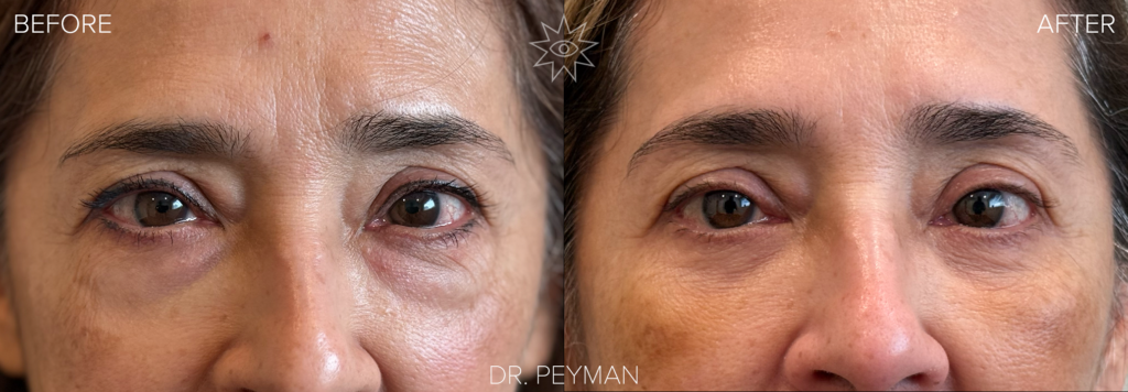 Before and five‑days‑after transconjunctival lower eyelid blepharoplasty showing prominent under‑eye bags reduced to a smoother, less puffy appearance with mild swelling and no external scar, performed by oculofacial plastic surgeon Dr. Jason Sabet‑Peyman in Fullerton, Orange County.