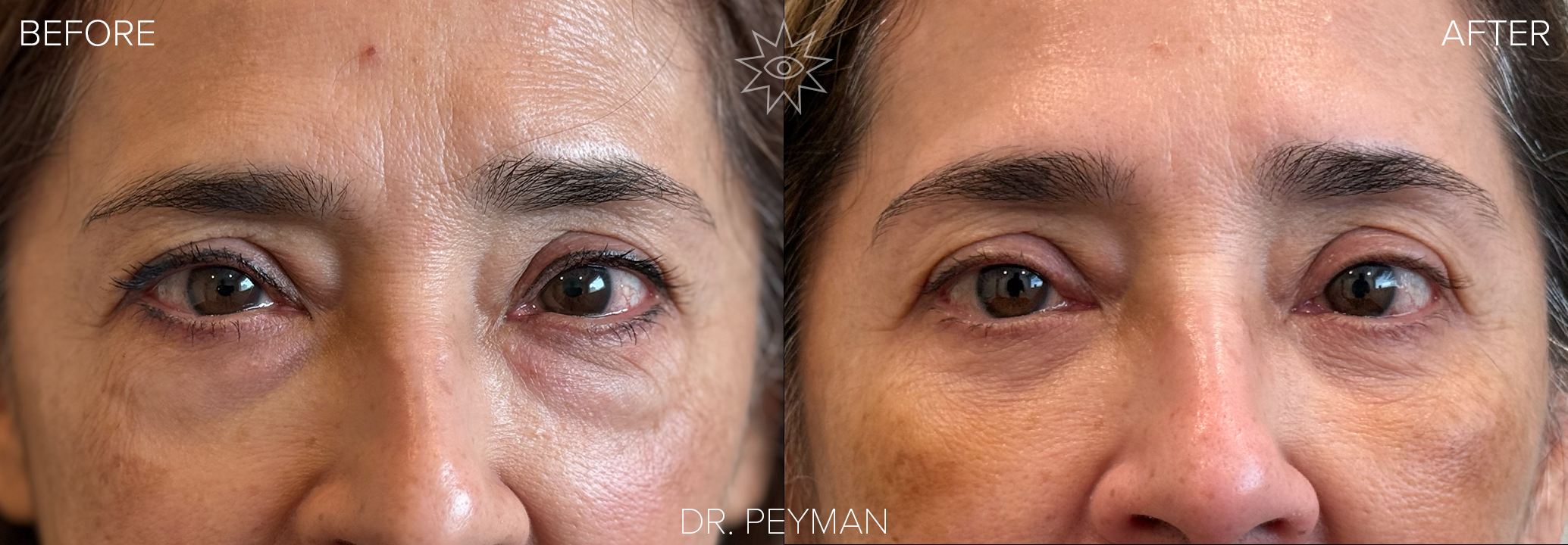 Before and five‑days‑after transconjunctival lower eyelid blepharoplasty showing prominent under‑eye bags reduced to a smoother, less puffy appearance with mild swelling and no external scar, performed by oculofacial plastic surgeon Dr. Jason Sabet‑Peyman in Fullerton, Orange County.