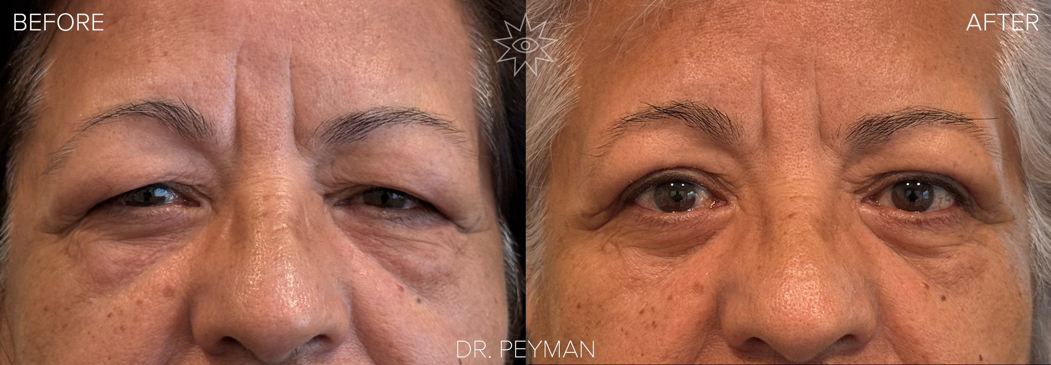 Before and after upper eyelid blepharoplasty in a mature patient showing heavy, hooded upper lids improved to a more open, rested appearance while maintaining a natural look, performed by oculofacial plastic surgeon Dr. Jason Sabet‑Peyman in Fullerton, Orange County.