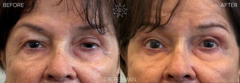 Before and after ptosis repair showing a woman with a previously droopy upper eyelid and smaller‑appearing eye, now with more open, balanced eyelids and a brighter gaze.