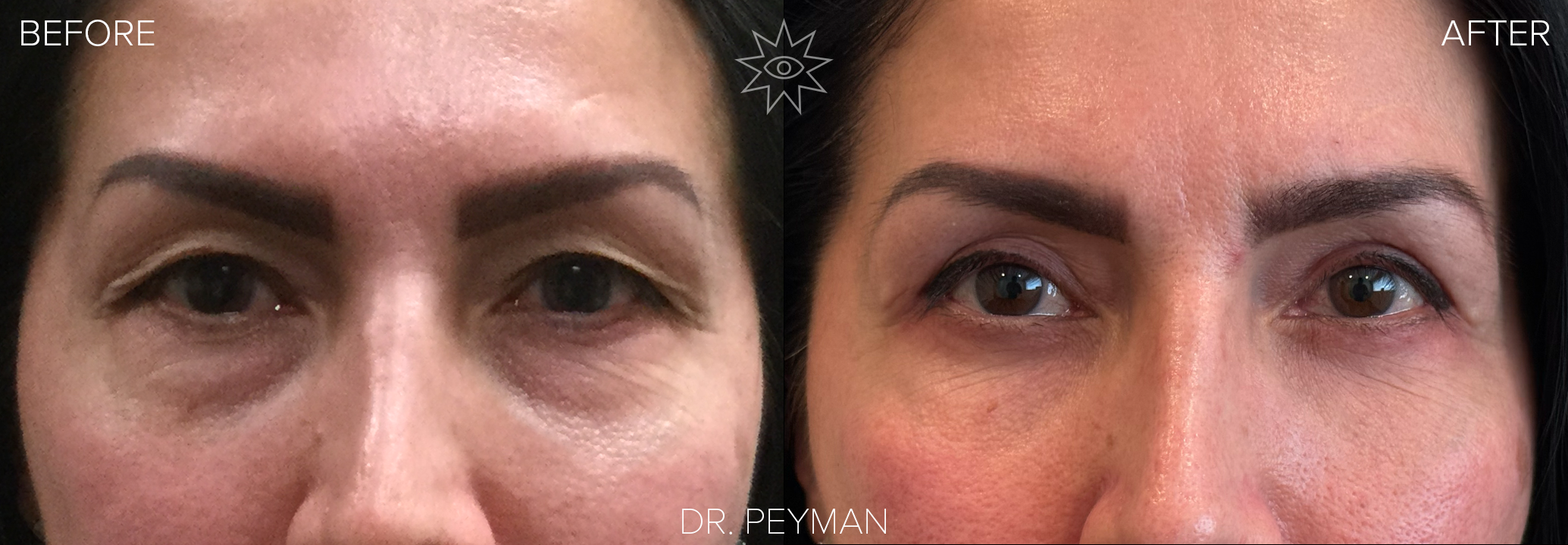 Before and after upper and lower eyelid blepharoplasty in a woman with upper eyelid skin sagging over her eyelashes and under eye bags, now showing a cleaner upper eyelid crease with visible lashes and smoother lower lids after surgery with oculofacial plastic surgeon Dr. Jason Sabet Peyman in Fullerton, Orange County.