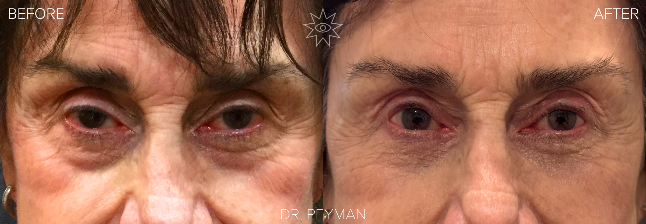 Before and after ptosis repair and upper eyelid blepharoplasty in a woman with a droopy upper eyelid and asymmetry between the eyes, now showing more open, balanced eyelids while keeping a natural eye and brow shape, performed by oculofacial plastic surgeon Dr. Jason Sabet Peyman in Fullerton, Orange County.