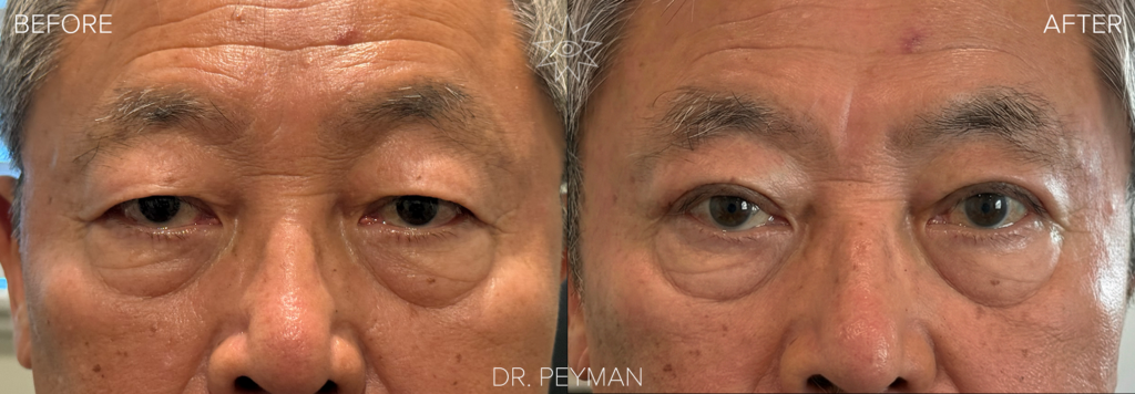 Before and after Asian upper eyelid blepharoplasty in a male patient showing heavy, puffy upper eyelids improved to a cleaner upper lid contour while under eye bags are unchanged, performed by oculofacial plastic surgeon Dr. Jason Sabet Peyman in Fullerton, Orange County.
