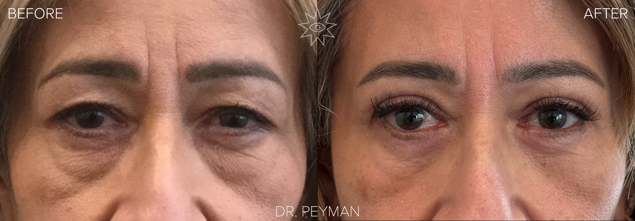 Before and after upper and lower eyelid blepharoplasty in a middle aged woman showing heavy upper lids and under eye bags improved to a cleaner, more open eye contour while maintaining a natural look, performed by oculofacial plastic surgeon Dr. Jason Sabet Peyman in Fullerton, Orange County.