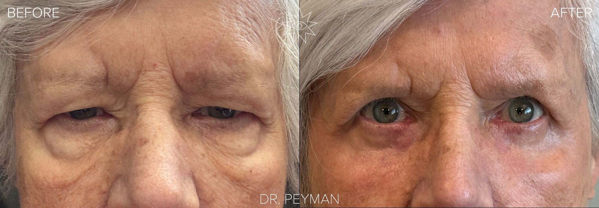 Happy female patient smiling after a successful upper and lower blepharoplasty eyelid surgery with top Orange County oculoplastic surgeon Dr. Peyman.