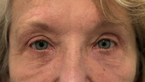 Same woman with open bright eyes and smooth under eye contour after quad bleph eyelid surgery by oculoplastic surgeon Dr. Peyman in Orange County CA.
