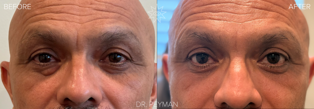 Before Photo Alt Text: A man with visible fat pad herniation under his right lower eyelid before lower blepharoplasty with Dr. Peyman in Fullerton CA. After Photo Alt Text: Same man with smooth, balanced under eye area and no visible fat pad after lower eyelid fat removal by oculoplastic surgeon Dr. Peyman in Orange County.