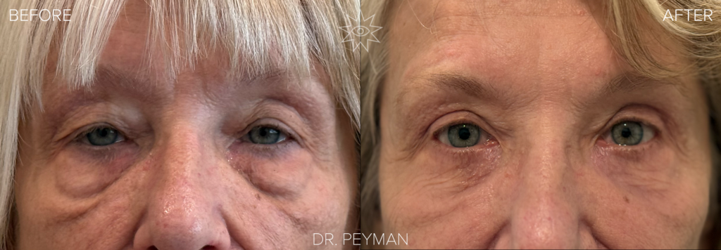 Woman with heavy drooping upper eyelids and under eye fat bags before and after combined upper and lower blepharoplasty with Dr. Peyman in Fullerton CA.