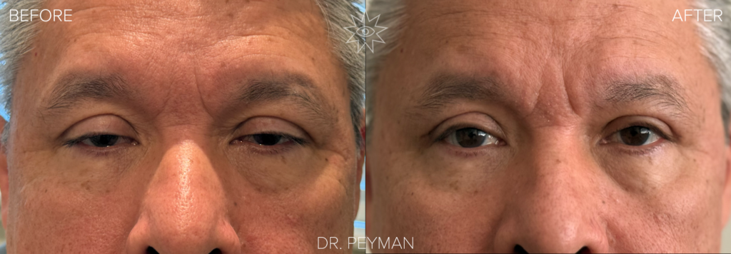 Man with severely drooping upper eyelids barely open before and fully open bright natural eyes after bilateral ptosis repair covered by insurance with Dr. Peyman in Fullerton Orange County CA.