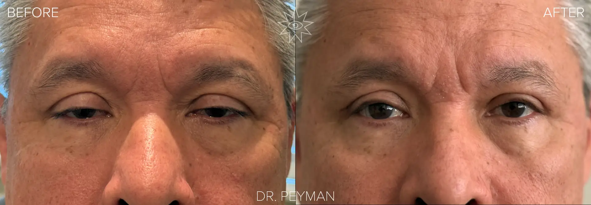 Man with severely drooping upper eyelids barely open before and fully open bright natural eyes after bilateral ptosis repair covered by insurance with Dr. Peyman in Fullerton Orange County CA.