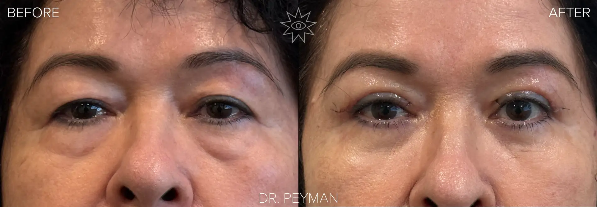 Woman with heavy upper eyelids and prominent lower eyelid fat bags before upper and lower blepharoplasty and same woman showing dramatically reduced swelling and refreshed eyes only 10 days after combined eyelid surgery by Dr. Peyman in Fullerton Orange County CA.