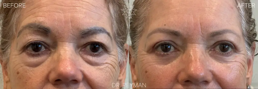 Woman with heavy hooded upper eyelids and prominent lower eyelid fat bags before and bright energized vibrant eyes after combined upper and lower blepharoplasty by oculoplastic surgeon Dr. Peyman in Fullerton Orange County CA.