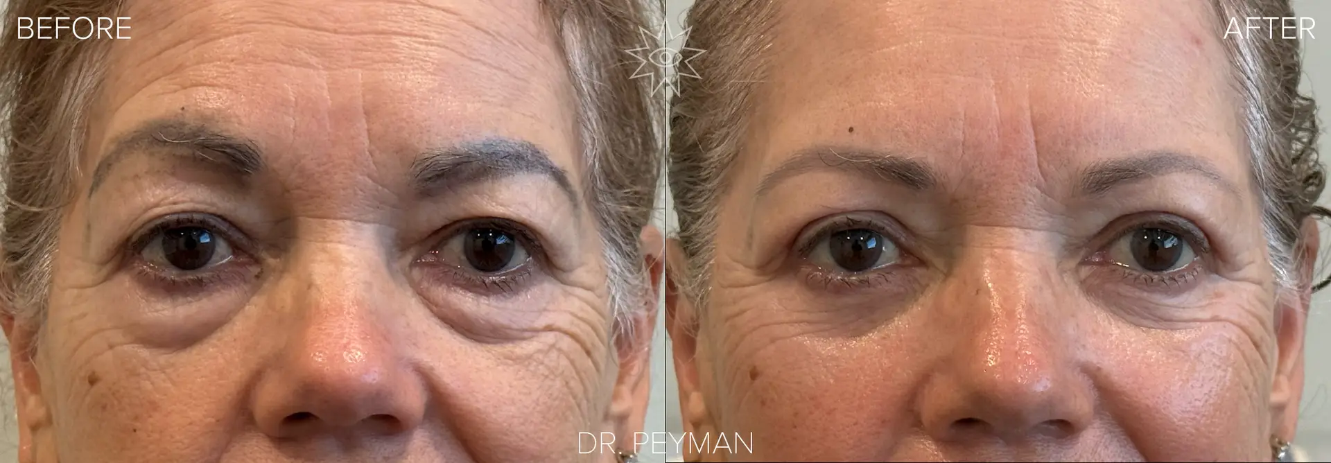 Woman with heavy hooded upper eyelids and prominent lower eyelid fat bags before and bright energized vibrant eyes after combined upper and lower blepharoplasty by oculoplastic surgeon Dr. Peyman in Fullerton Orange County CA.