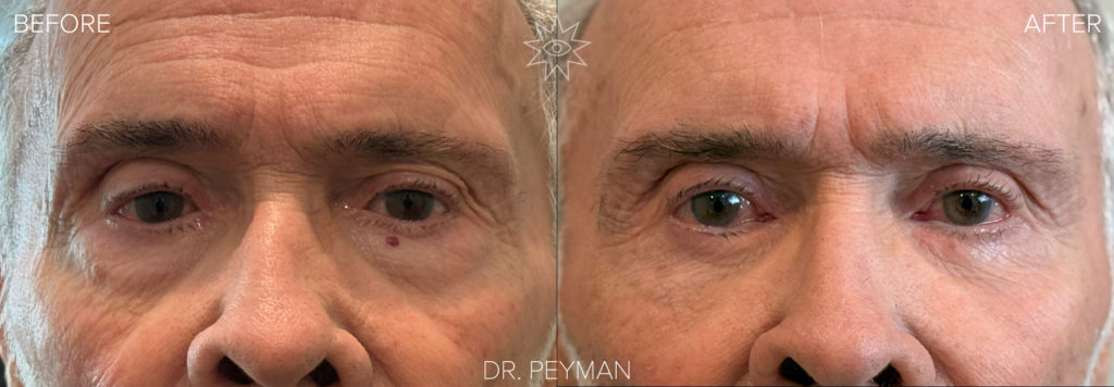 Man with drooping upper eyelids, particularly the left upper eyelid, and lower eyelid bags before, and alert, open, bright eyes one month after upper and lower blepharoplasty by Dr. Peyman in Fullerton Orange County CA.