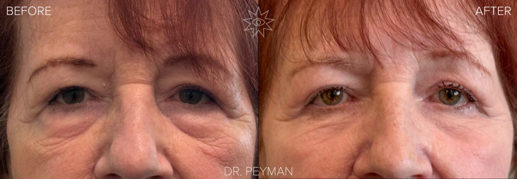 Woman with heavy, hooded upper eyelids and under eye bags before, and bright, open, refreshed green eyes one month after upper and lower blepharoplasty by Dr. Peyman in Fullerton Orange County CA.