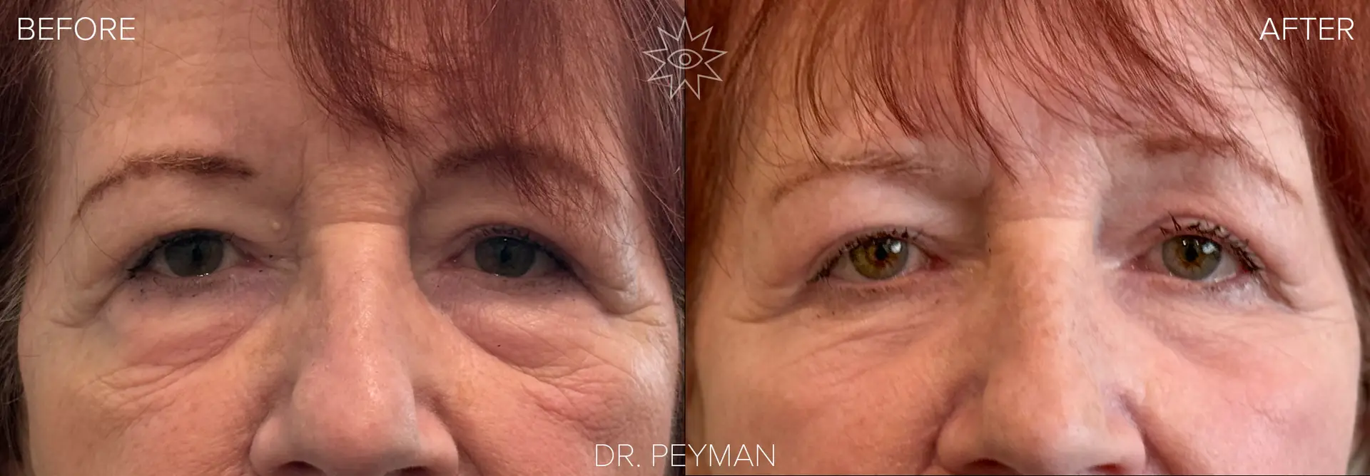 Woman with heavy, hooded upper eyelids and under eye bags before, and bright, open, refreshed green eyes one month after upper and lower blepharoplasty by Dr. Peyman in Fullerton Orange County CA.