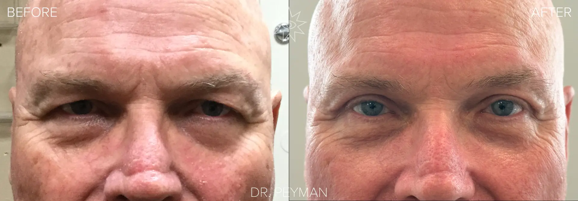 Before: Man with severely hooded and heavy upper eyelids creating an angry stern expression before upper blepharoplasty with Dr. Peyman in Fullerton CA. After: Man with fully open bright eyes and a relaxed friendly expression after upper eyelid surgery by oculoplastic surgeon Dr. Peyman in Orange County CA.