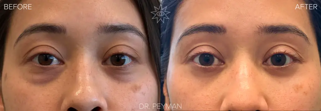 Young woman in her 30s with prominent lower eyelid fat herniation and under eye bags before and smooth bright naturally refreshed under eye area after lower blepharoplasty by oculoplastic surgeon Dr. Peyman in Fullerton Orange County CA.