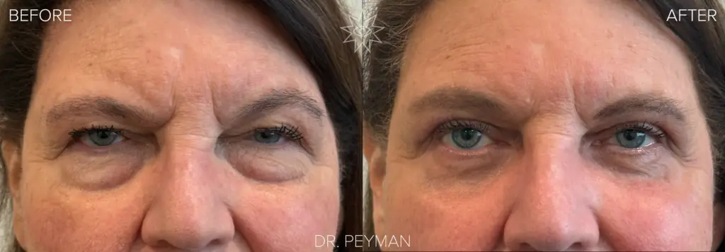 Before photo of a woman with heavy upper eyelid hooding and under-eye bags prior to quad blepharoplasty and fter photo showing natural, refreshed results following upper and lower blepharoplasty by Dr. Jason Sabet-Peyman in Fullerton, Orange County CA