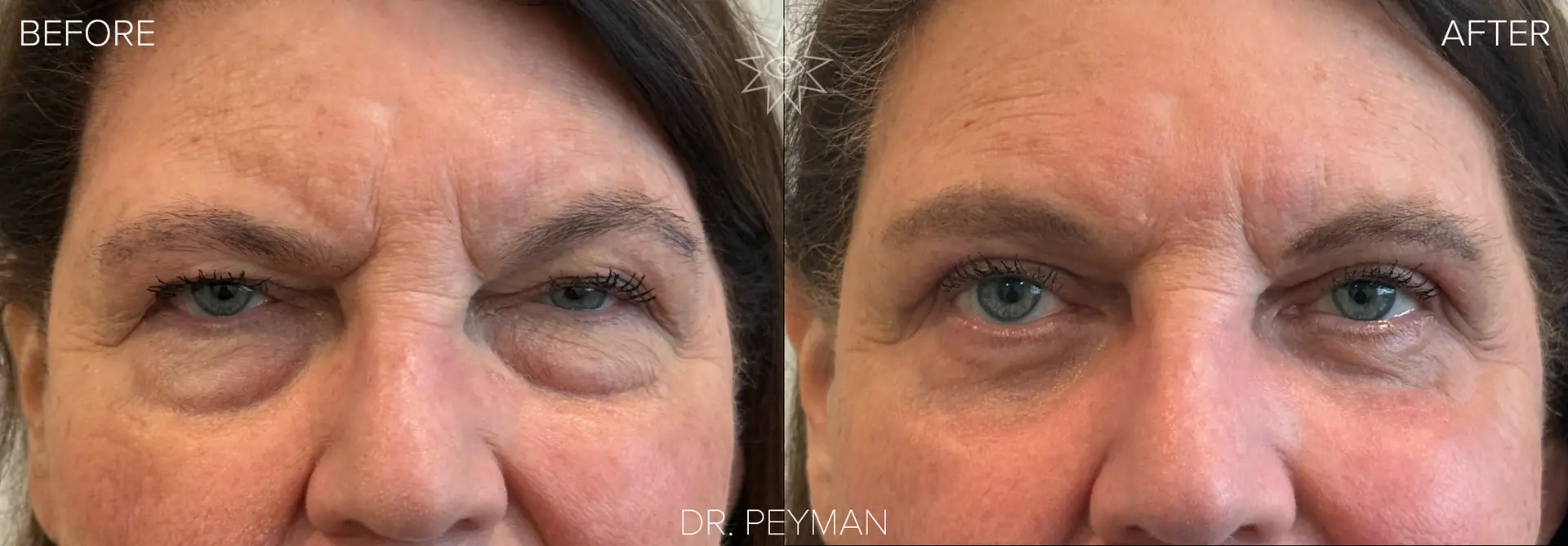 Before photo of a woman with heavy upper eyelid hooding and under-eye bags prior to quad blepharoplasty and fter photo showing natural, refreshed results following upper and lower blepharoplasty by Dr. Jason Sabet-Peyman in Fullerton, Orange County CA