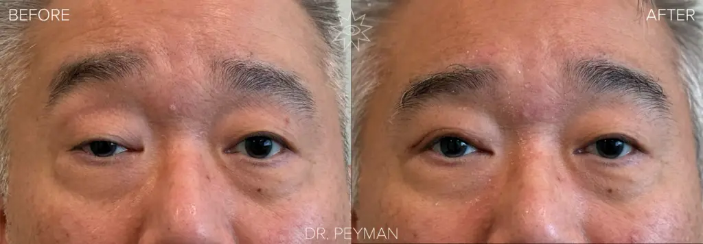 Before photo of a male patient with unilateral ptosis showing the right upper eyelid drooping significantly lower than the left, prior to ptosis repair
