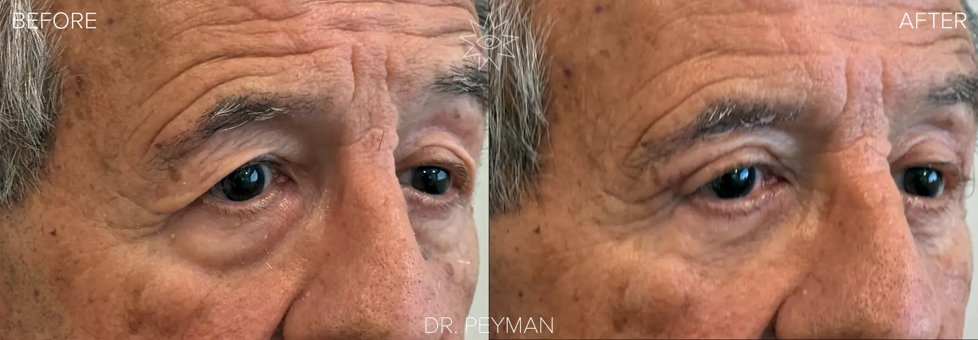 Elderly man in his 80s with severely hooded upper eyelids and prominent lower eyelid fat bags before and naturally refreshed open alert eyes after combined upper and lower blepharoplasty quad bleph by Dr. Peyman in Fullerton Orange County CA.