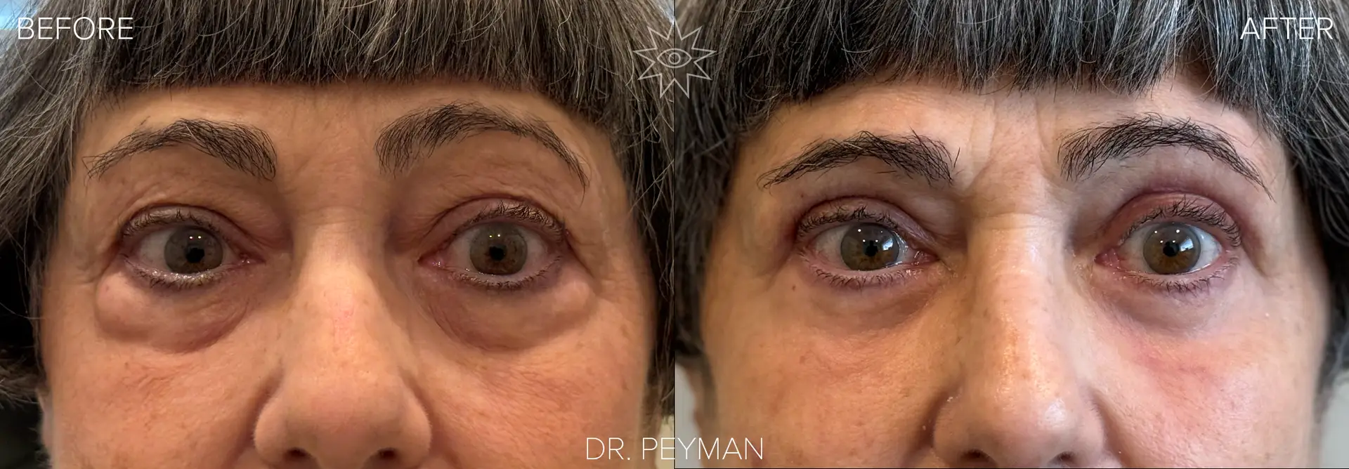Woman with under eye uneven fat bags before and after combined upper and lower blepharoplasty with Dr. Peyman in Fullerton CA.