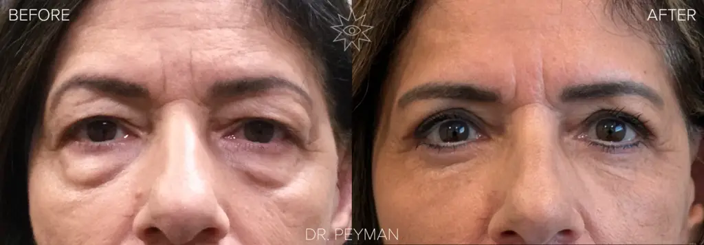 63-year-old quad blepharoplasty before and after by Dr. Peyman, Fullerton CA — upper and lower eyelid surgery results