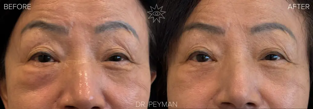 Before and after removal of a right orbital tumor by Dr. Jason Sabet-Peyman in Fullerton, CA. The before image shows a firm lump under the right lower eyelid that was mistaken for an eye bag. The after image shows a smooth, natural lower eyelid contour with no external scarring.