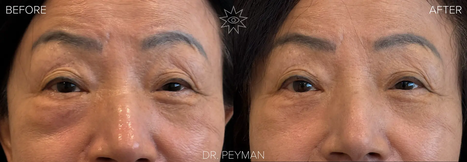 Before and after removal of a right orbital tumor by Dr. Jason Sabet-Peyman in Fullerton, CA. The before image shows a firm lump under the right lower eyelid that was mistaken for an eye bag. The after image shows a smooth, natural lower eyelid contour with no external scarring.
