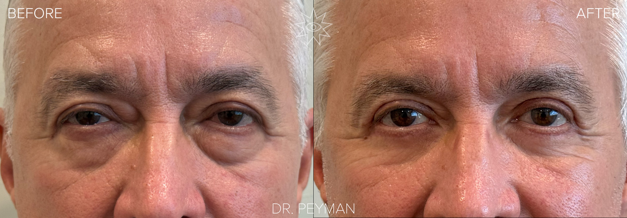 Before and after upper blepharoplasty and lower blepharoplasty with skin pinch on a male patient with hooded upper eyelids and under-eye bags, front view, by Dr. Jason Sabet-Peyman in Fullerton, CA