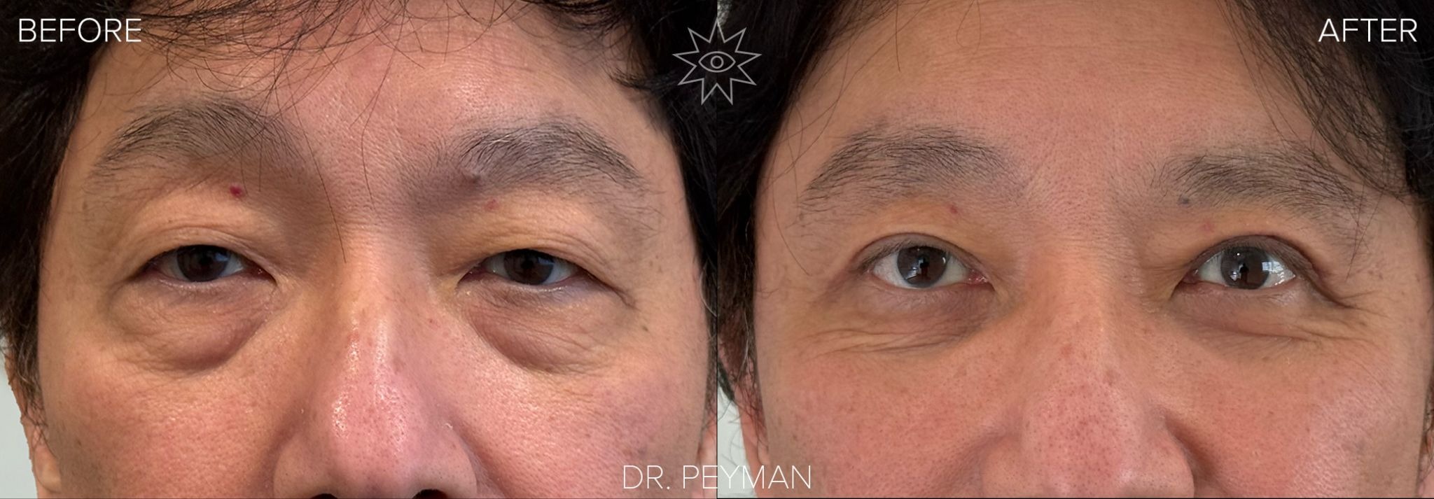 Before and after quad blepharoplasty on a male patient with upper eyelid hooding and under-eye bags, front view, by Dr. Jason Sabet-Peyman in Fullerton, CA