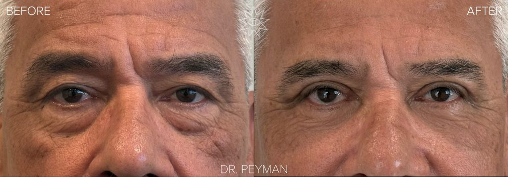 Before and after quad blepharoplasty on a male patient with hooded upper eyelids and under-eye bags more pronounced on one side, front view, by Dr. Jason Sabet-Peyman in Fullerton, CA