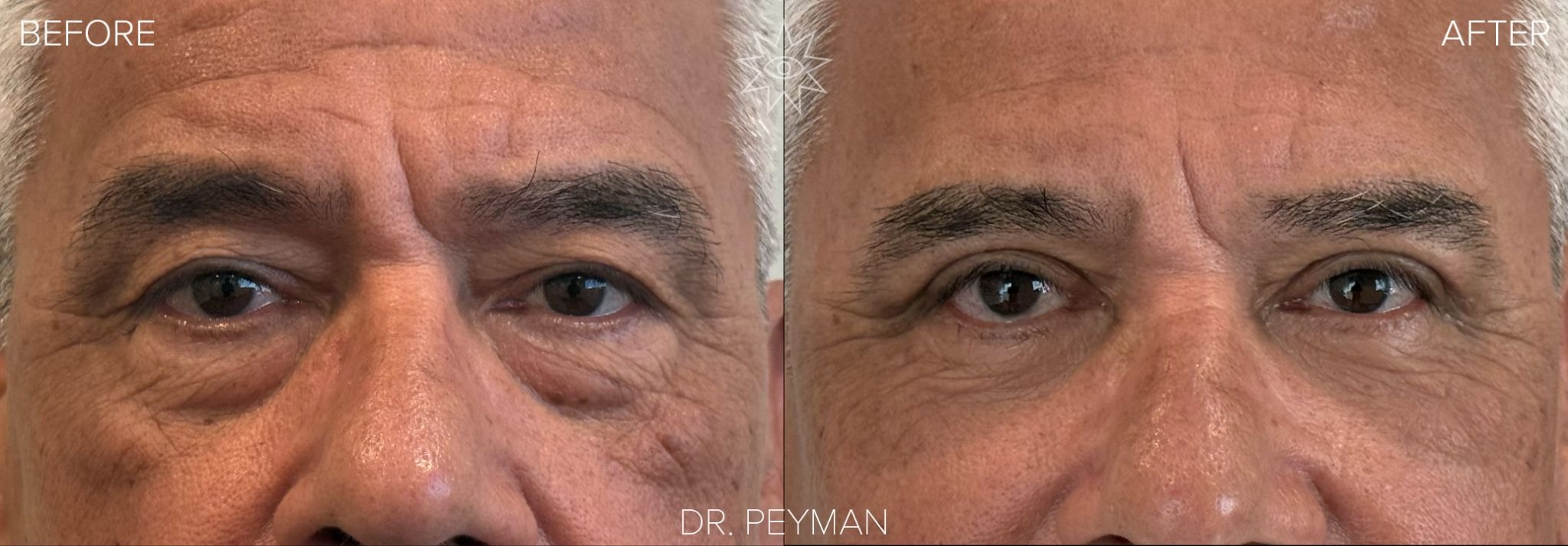 Before and after quad blepharoplasty on a male patient with hooded upper eyelids and under-eye bags more pronounced on one side, front view, by Dr. Jason Sabet-Peyman in Fullerton, CA