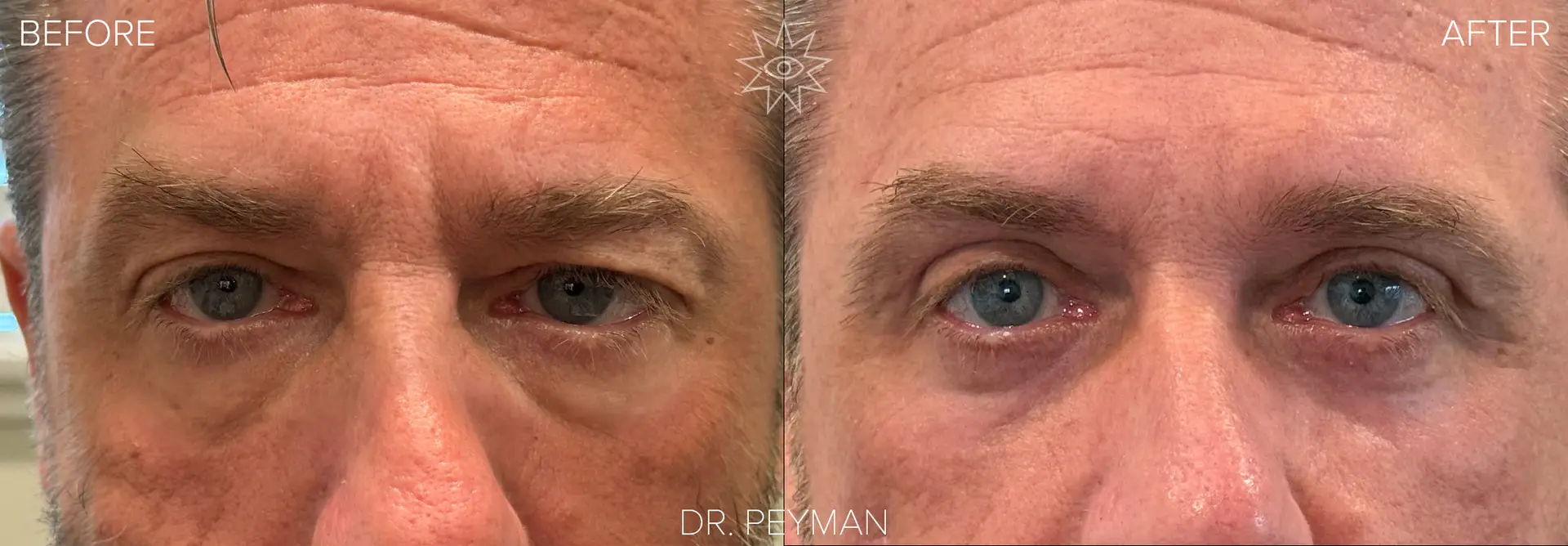 Before and after upper blepharoplasty on a male patient with excess upper eyelid skin resting on the lash line, front view, by Dr. Jason Sabet-Peyman in Fullerton, CA
