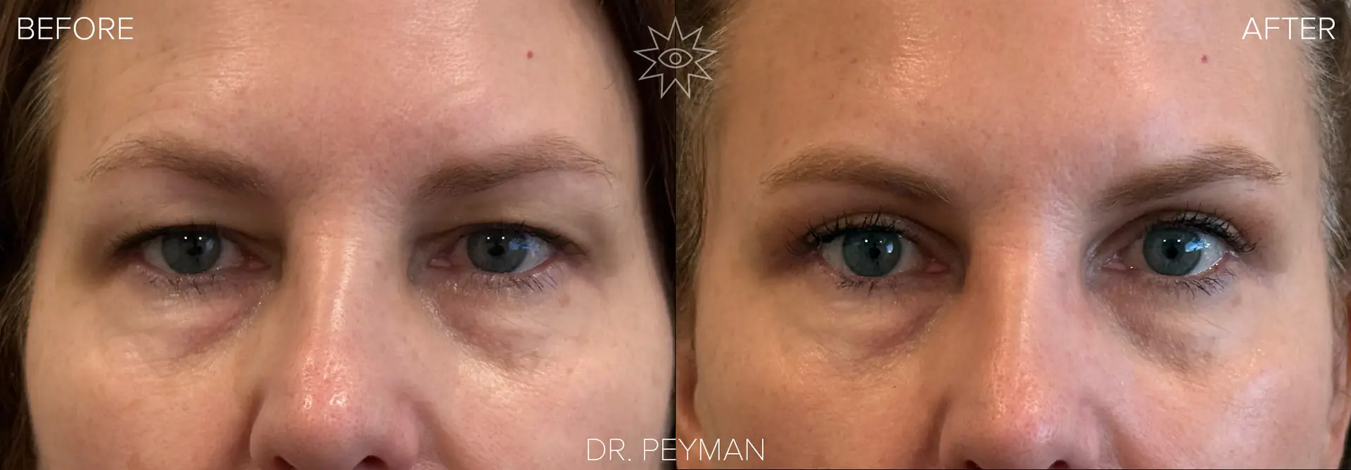 Before and after upper blepharoplasty showing reduced upper eyelid hooding and a more visible natural eyelid crease.