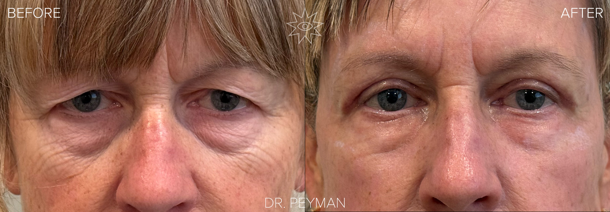 Before and after upper blepharoplasty and full-face laser skin resurfacing showing reduced upper eyelid hooding and smoother facial skin texture.