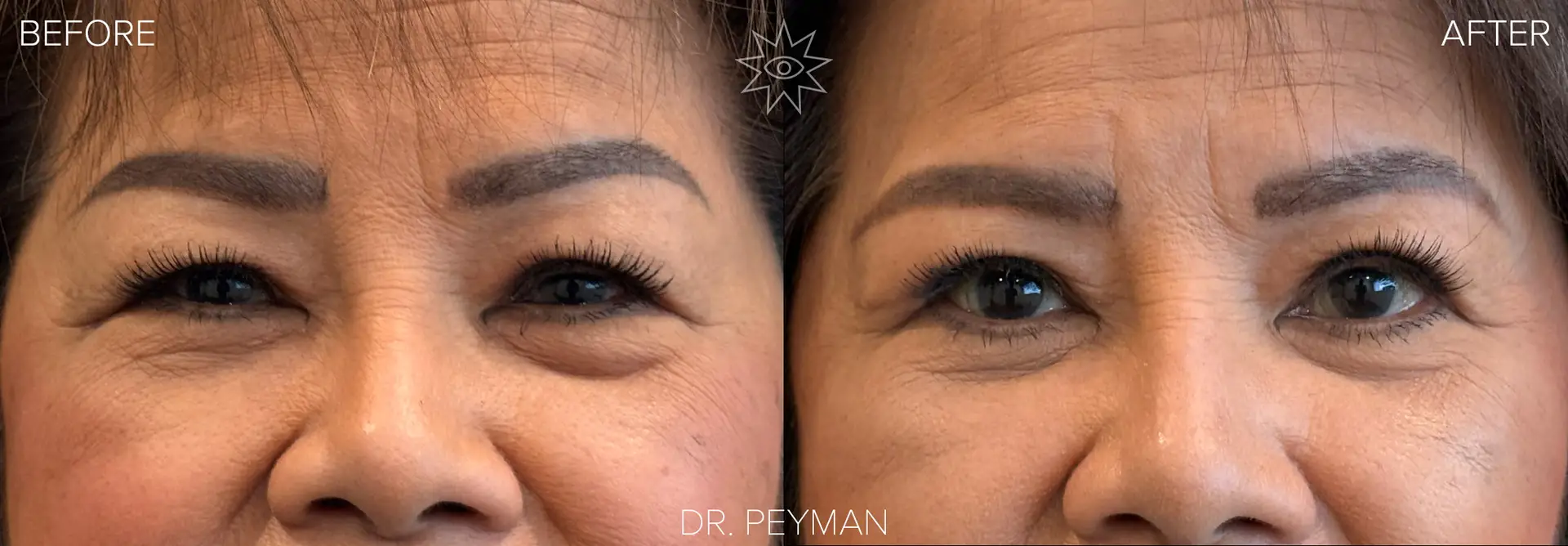 Before and after upper and lower blepharoplasty showing reduced upper eyelid hooding and under-eye bags.